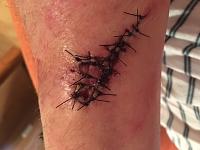 Click image for larger version

Name:	skin graft.JPG
Views:	98
Size:	84.9 KB
ID:	45128